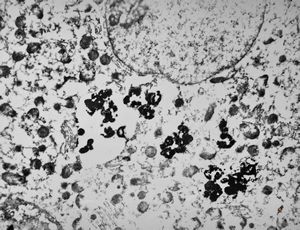 M,66y. | siderosomes M,66y. | siderosomes